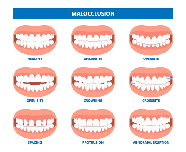 malocclusion chart